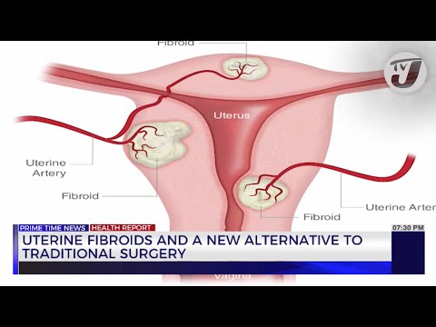 Uterine Fibroids and a New Alternative to Traditional Surgery | TVJ News